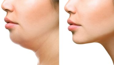Get Rid of Neck Fat - How to get rid of neck fat, causes of thick neck