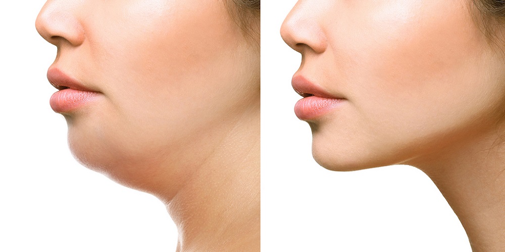 Get Rid of Neck Fat - How to get rid of neck fat, causes of thick neck