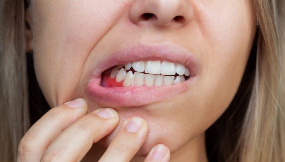 Early Stage of Gum Disease, periodontal disease