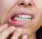 Early Stage of Gum Disease, periodontal disease