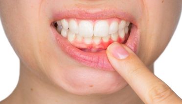 How to Reverse Gum Recession Naturally