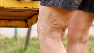 early stage varicose veins symptoms early stage varicose veins stages start of varicose veins beginning of varicose veins varicose veins beginning early varicose veins early stage varicose veins feet early stages of varicose veins