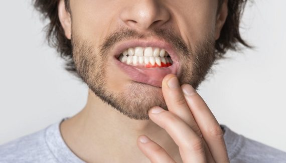 Foods to avoid with receding gums