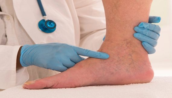 when to worry about varicose veins